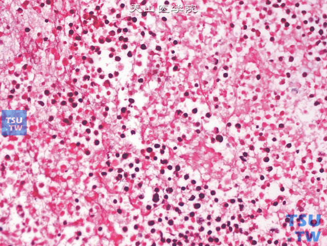 膀胱小细胞癌，示瘤细胞呈未分化的小细胞癌特征，可见坏死及核分裂象（位于图中央）
