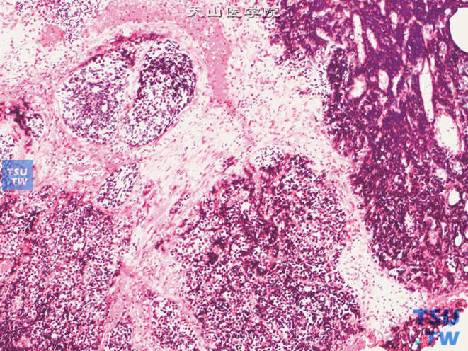膀胱小细胞癌与高级别尿路上皮癌并存