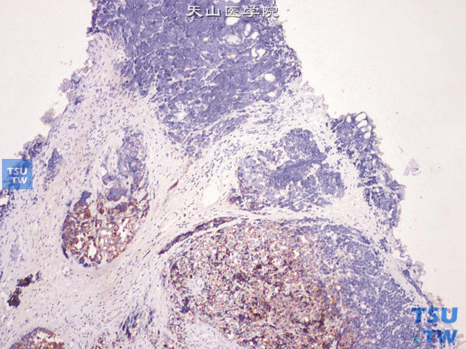 膀胱小细胞癌与高级别尿路上皮癌并存，其中尿路上皮癌成分CK7（+），小细胞癌成分CK7（-）