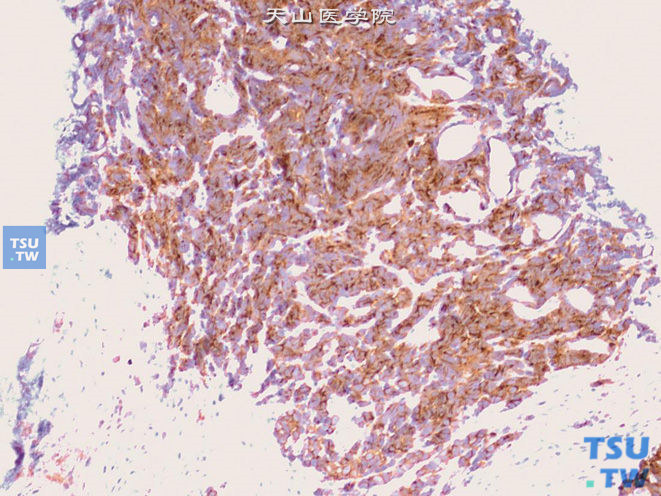 膀胱小细胞癌与高级别尿路上皮癌并存，其中小细胞癌成分Syn（+）