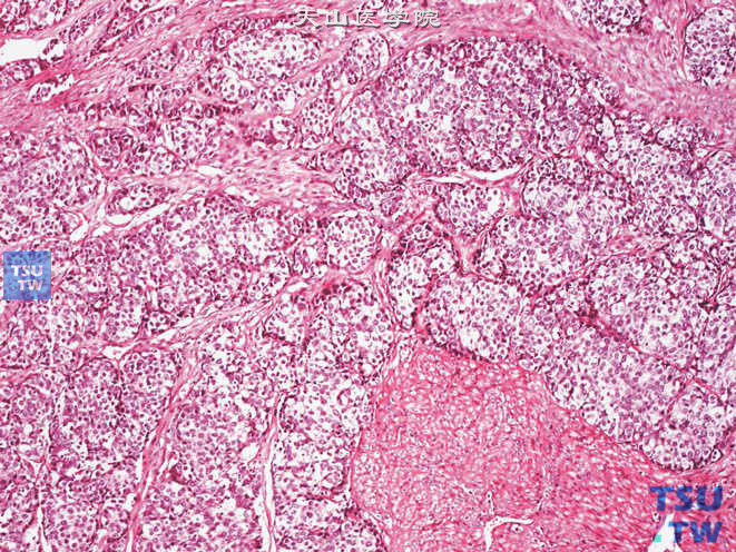 膀胱类癌，瘤细胞排列成岛状，胞质丰富，双嗜色性