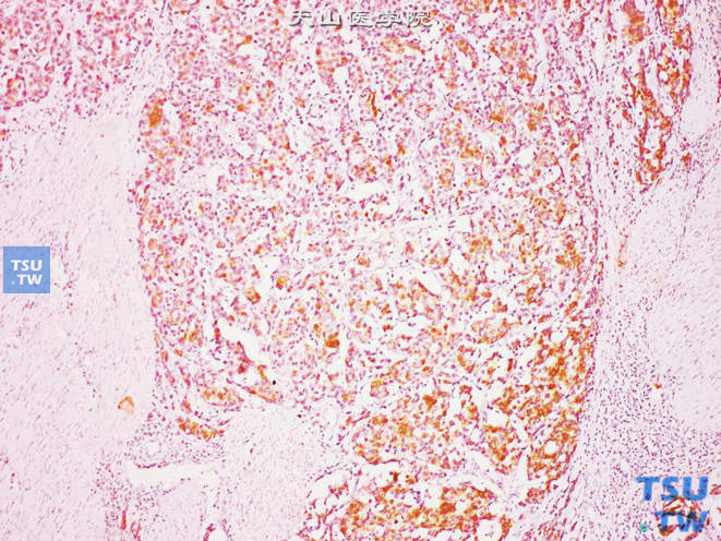 膀胱类癌，广谱CK（+）（此例CK7阴性，与尿路上皮癌，巢状亚型不同）