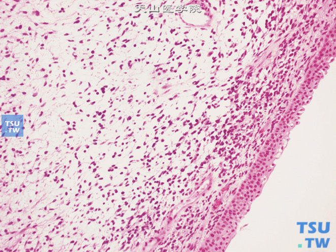 膀胱颈葡萄状胚胎性横纹肌肉瘤，和表面上皮紧邻的瘤细胞致密排列，形成生发层，伴丰富的疏松黏液样间质