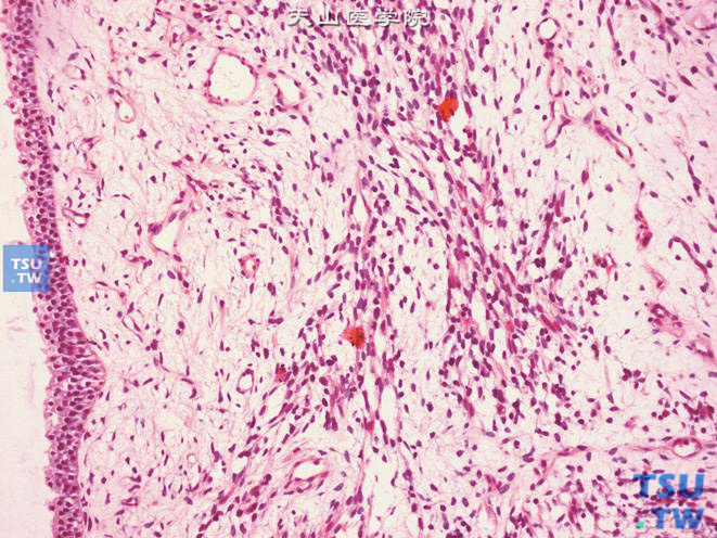 膀胱颈葡萄状胚胎性横纹肌肉瘤，瘤细胞呈线状排列，可见胞质嗜酸的瘤细胞