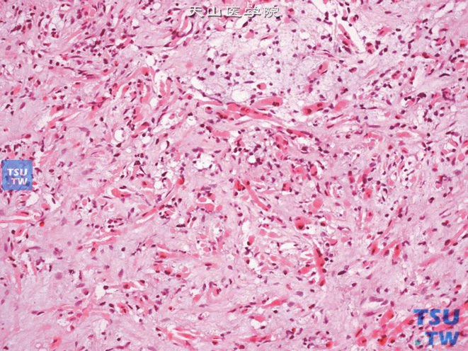 膀胱颈葡萄状胚胎性横纹肌肉瘤，可见胞质嗜酸的横纹肌母细胞