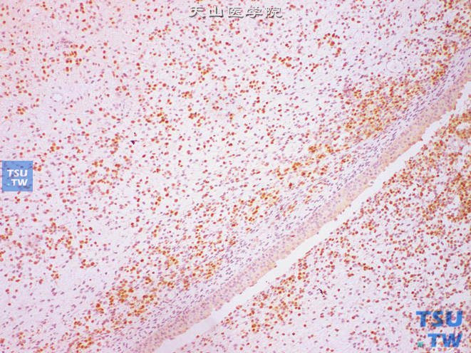 膀胱颈葡萄状胚胎性横纹肌肉瘤，MyoD1（+）