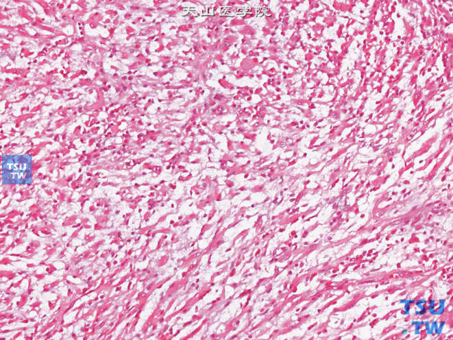 膀胱胚胎性横纹肌肉瘤，可见圆形的横纹肌母细胞及多核带状细胞，位于黏液样间质中