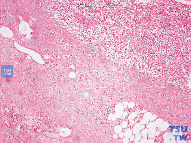 膀胱胚胎性横纹肌肉瘤，此例肿瘤向深部浸润性生长，局部达膀胱周围脂肪