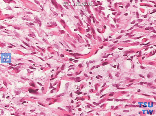 膀胱胚胎性横纹肌肉瘤，细胞呈带状，胞质红染