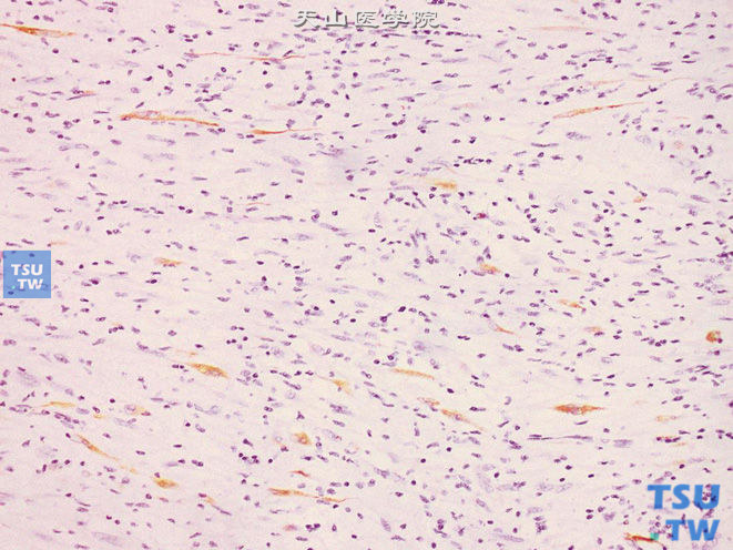 膀胱胚胎性横纹肌肉瘤，示部分成肌性分化的细胞Des（+）