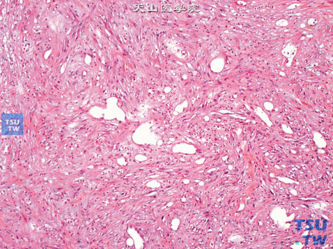 膀胱低度恶性肌纤维母细胞肉瘤，示梭形肿瘤细胞排列成编席状结构