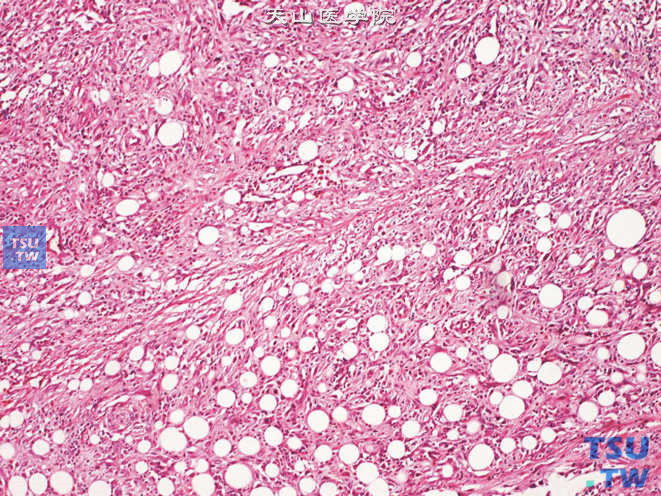 膀胱低度恶性肌纤维母细胞肉瘤，示瘤细胞弥漫浸润性生长，侵犯膀胱周围脂肪