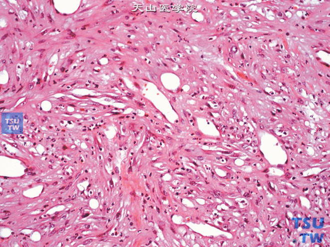 膀胱低度恶性肌纤维母细胞肉瘤，示瘤细胞胞质界限不清，浅嗜酸性。细胞核具中度非典型性，部分细胞核呈空泡状，可见小核仁