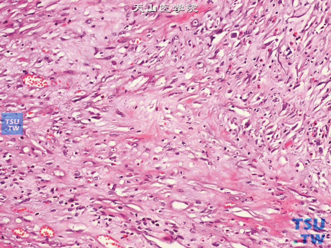 膀胱低度恶性肌纤维母细胞肉瘤，部分区域细胞含量少，间质可见胶原成分