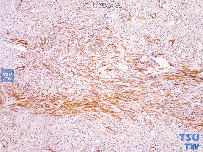 膀胱低度恶性肌纤维母细胞肉瘤，示SMA（+）