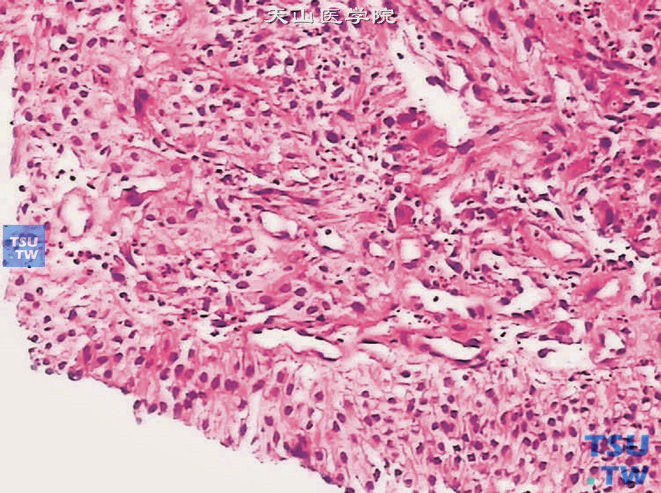 膀胱恶性纤维组织细胞瘤，示肿瘤与黏膜被覆上皮相邻