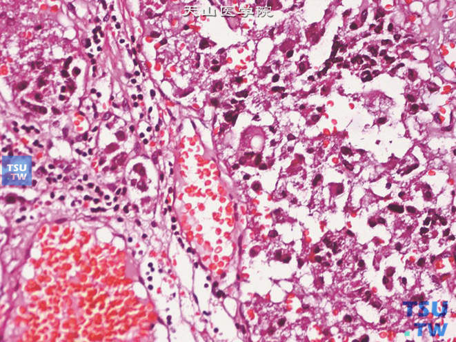 恶性嗜铬细胞瘤，示细胞异型及核分裂象