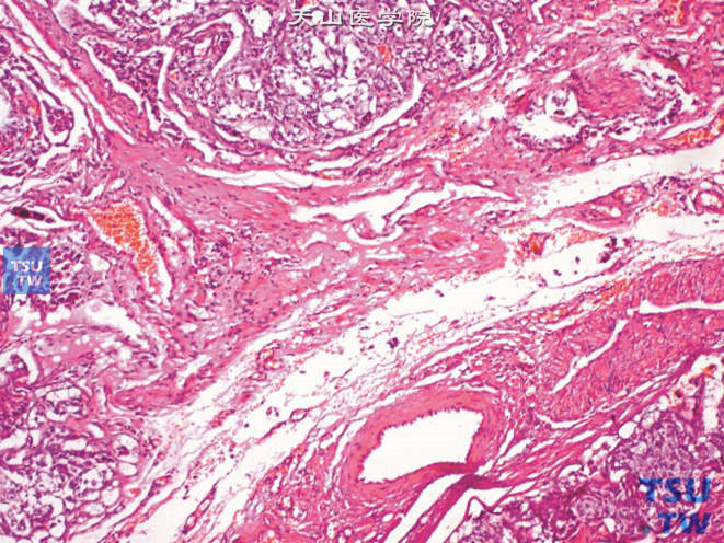 恶性嗜铬细胞瘤，示肿瘤浸润周围结缔组织