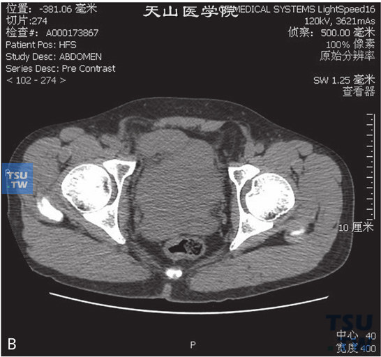 图B：CT膀胱前列腺淋巴瘤，男，52岁，排尿困难，下腹部坠胀感。膀胱、前列腺、精囊腺见软组织密度灶，边缘欠清晰，前列腺包膜尚光整。腹盆腔及腹膜后未见明显增大淋巴结