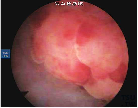 膀胱淋巴瘤（膀胱镜）。肿瘤呈团块状，无蒂，或呈息肉样。被覆肿瘤表面的黏膜常无改变