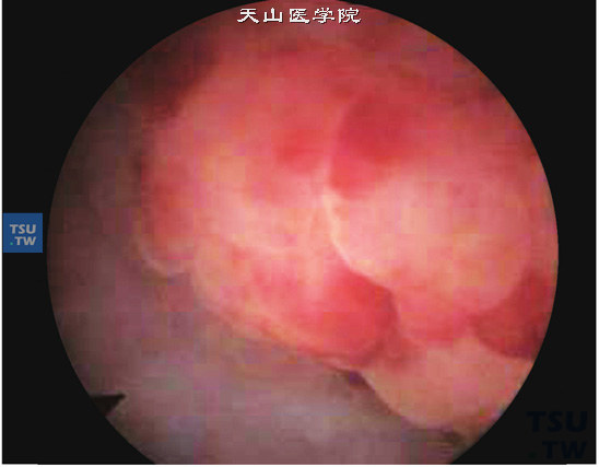 膀胱间叶恶性肿瘤病理图谱