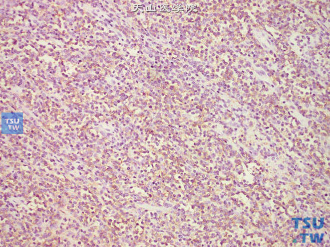 膀胱淋巴瘤。免疫组化：CD20（+）