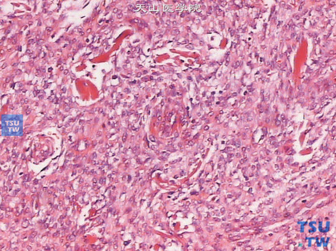 膀胱转移性低级别子宫内膜间质肉瘤（病史15年），可见丰富的小动脉