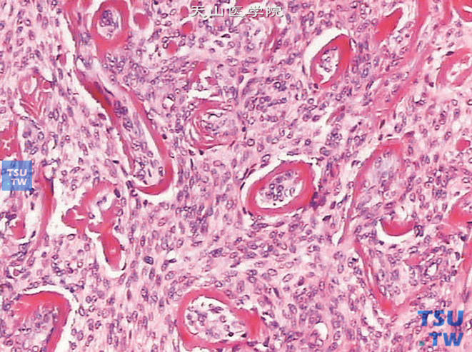 膀胱转移性低级别子宫内膜间质肉瘤（病史15年），示小动脉玻璃样变性