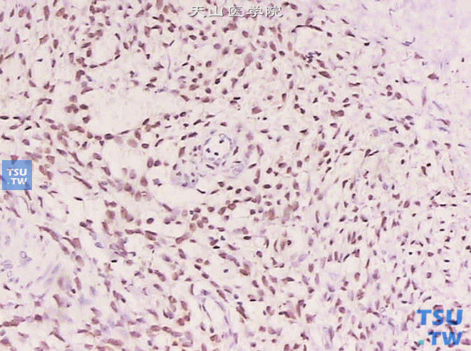 膀胱转移性低级别子宫内膜间质肉瘤（病史15年） PR（+）