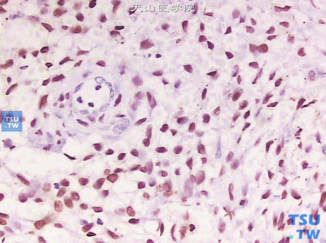 膀胱转移性低级别子宫内膜间质肉瘤（病史15年）PR（+）。上图高倍