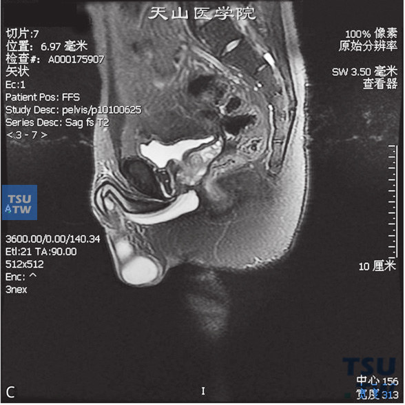 图C：MR，正常尿道