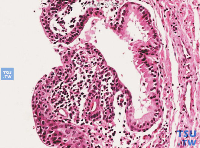非特异性尿道炎，尿道黏膜可见慢性炎细胞浸润
