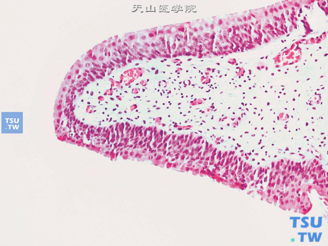 尿道纤维上皮性息肉，中央为纤维血管性间质，被覆尿路上皮，可伴鳞化