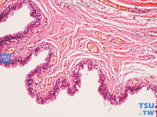 尿道旁腺囊肿，囊肿被覆柱状上皮，腔面胞质可见微绒毛样突起