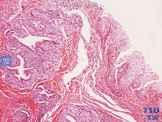 尿道肉阜，乳头状瘤样型，可见下陷的尿路上皮巢，中央可见被覆柱状上皮的腺样管腔