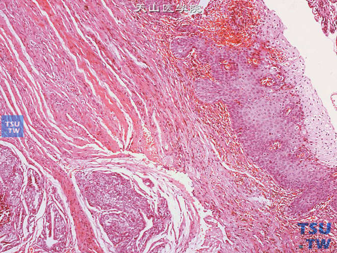 尿道肉阜，示鳞状上皮乳头状瘤样增生
