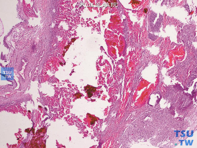 尿道肉阜，血管瘤样型，被覆上皮下可见大量扩张的毛细血管，似血管瘤