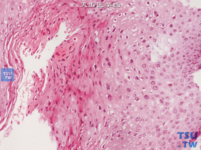 尿道尖锐湿疣。示凹空细胞及角化不全