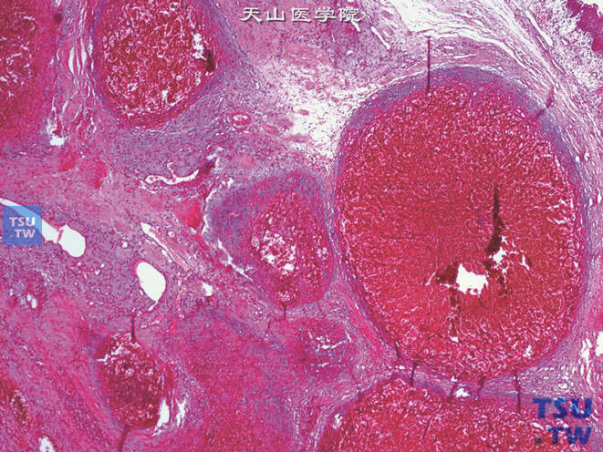 尿道外口血管瘤，管壁较厚，腔内充满红细胞