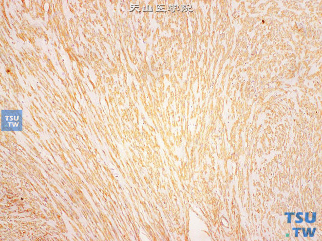 尿道外口平滑肌瘤，免疫组化：SMA（+）