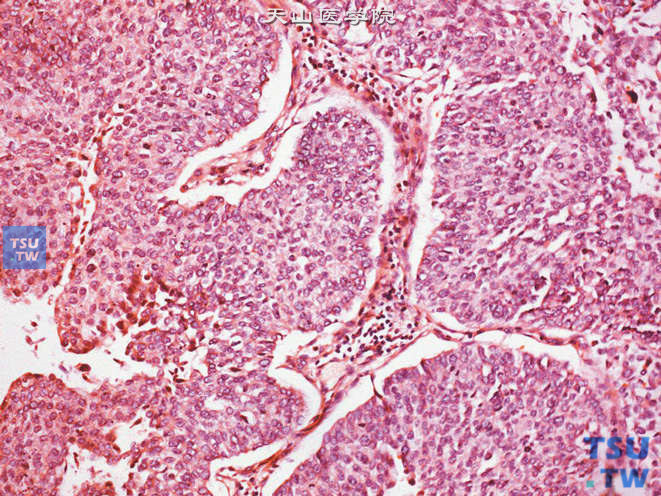 尿道乳头状低级别尿路上皮癌。细胞异型性不明显，极性存在