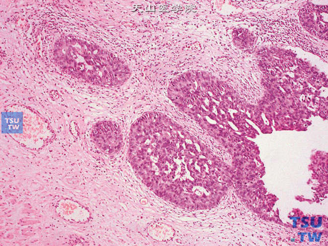 尿道浸润性高级别尿路上皮癌，示侵犯黏膜固有层