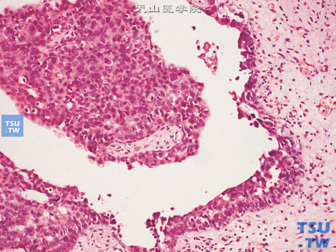 尿道浸润性高级别尿路上皮癌，示交界处黏膜可见尿路上皮原位癌