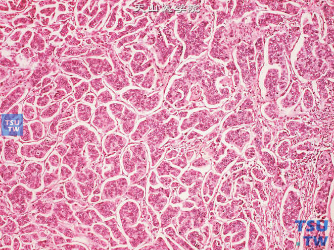 尿道高级别尿路上皮癌，可见乳头样及巢片状结构