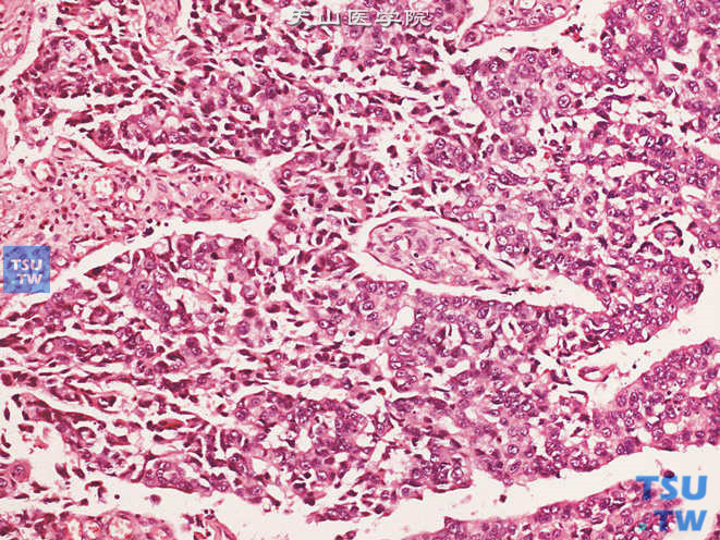 尿道高级别尿路上皮癌，可见融合的乳头样结构