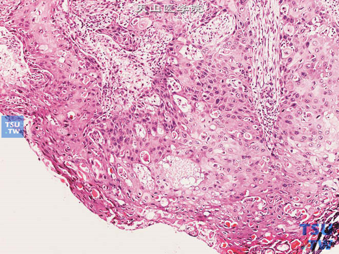 尿道鳞癌。可见角化。细胞异型明显，可见核分裂象