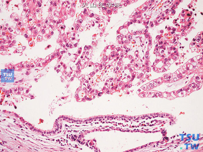 尿道腺癌，下方为尿道被覆上皮，呈分泌性上皮表现