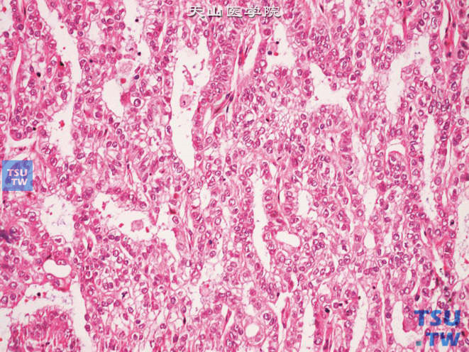 尿道腺癌，无特异性分化型