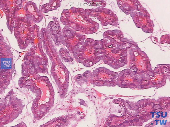 尿道外口腺癌，呈乳头状结构