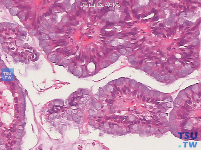 尿道外口腺癌，胞质内可见黏液分泌